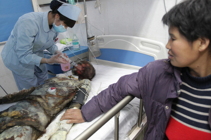 13岁女孩火海救母 全身95%被烧伤 _图片频道_财新网