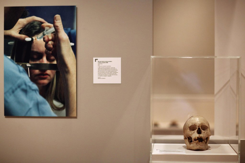 一个曾接受大脑手术的人类头骨。 Dan Kitwood/Getty Images/CFP_英国“人脑展”展出爱因斯坦大脑切片