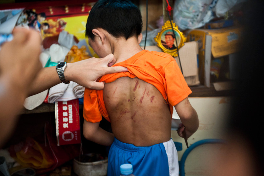 4月16日上午，东莞长安，小根背部伤痕累累。7岁男童小根遭养父虐待，养父称不打不成器，看得周边邻居心疼不已。  陈奕启/CFP_财新每周图片(2012.4.14-4.20) 