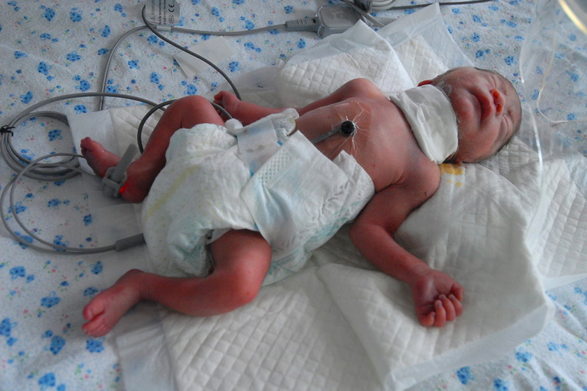 7月23日，辽宁鞍山，弃婴只有2斤8两，小小身躯就要承受割喉之痛。  东方IC_早产女婴遭割喉遗弃 经抢救脱离危险