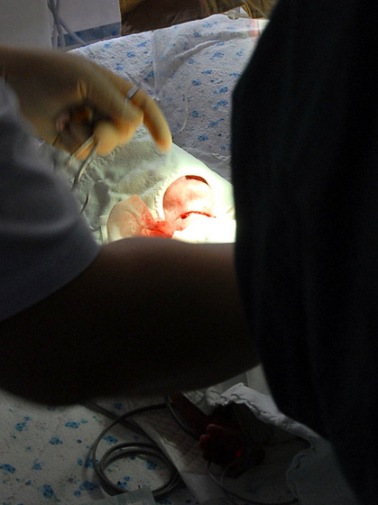 7月23日，辽宁鞍山，经过医生抢救，她活了下来。早产、憋闷的袋子、割喉都没要得了她的命。  东方IC_早产女婴遭割喉遗弃 经抢救脱离危险