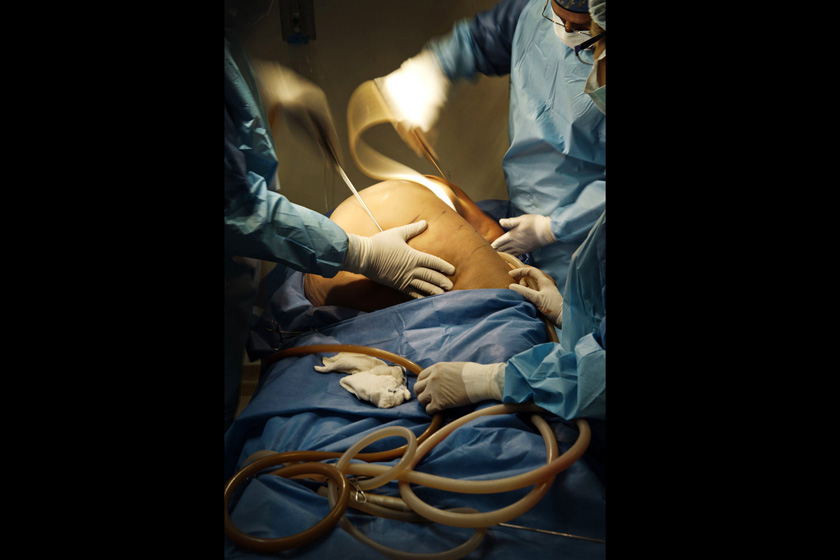 当地时间2012年6月18日，哥伦比亚波哥大，Morales医生和他的同事在为Brenda Fuentes做抽脂手术。   Moa Karlberg/东方IC _实拍哥伦比亚美容整形之旅